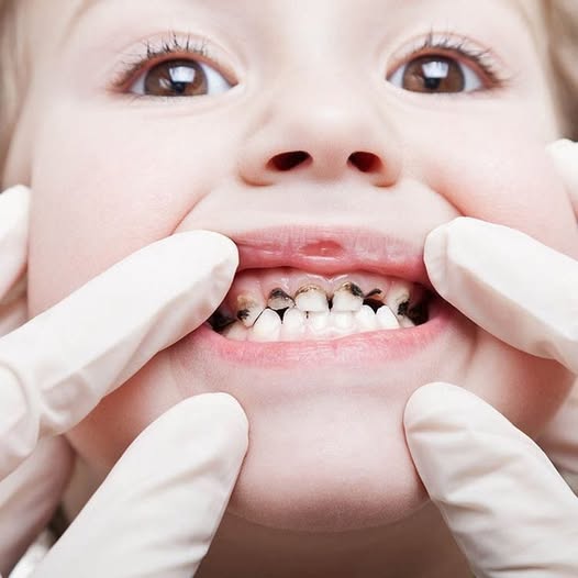 Xiết ăn răng ở trẻ em là gì?