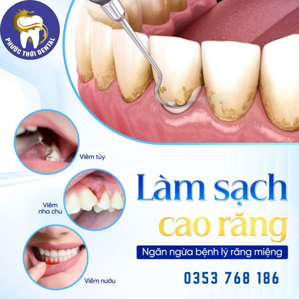 Làm Sạch Cao Răng - Giải Pháp Chủ Động Ngăn Ngừa Bệnh Lý Răng Miệng Nghiêm Trọng