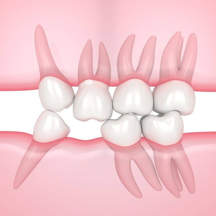 Mất răng không chỉ là thiếu 1 cái răng - 5 tác hại âm thầm nhưng cực kỳ nghiêm trọng