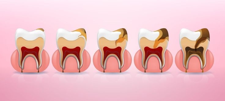 Các Giai Đoạn Tiến Triển Của Răng Sâu Bạn Cần Biết