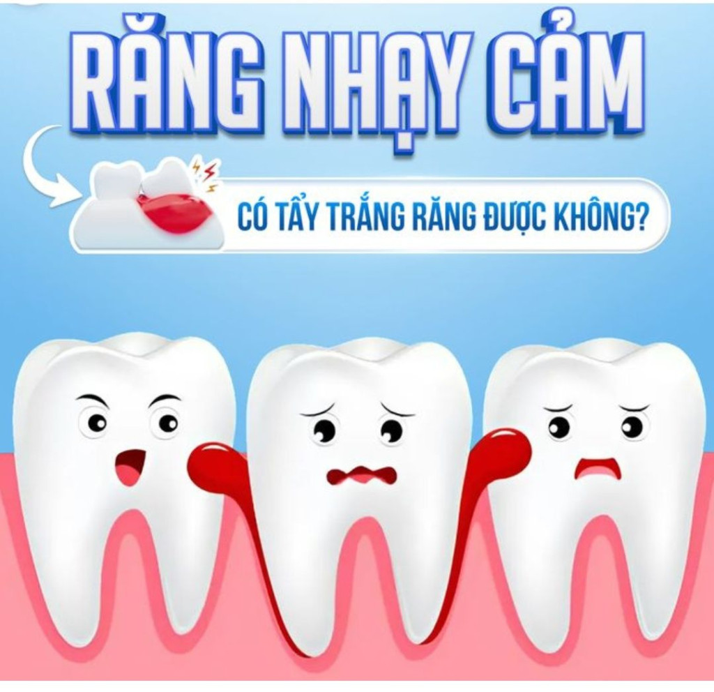 Răng Nhạy Cảm Có Tẩy Trắng Được Không? Giải Đáp Từ Chuyên Gia