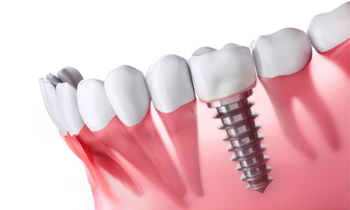 Trồng răng cấy ghép Implant